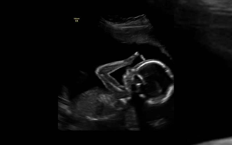 Bebê aparece em ultrassonografia fazendo o sinal da Cruz