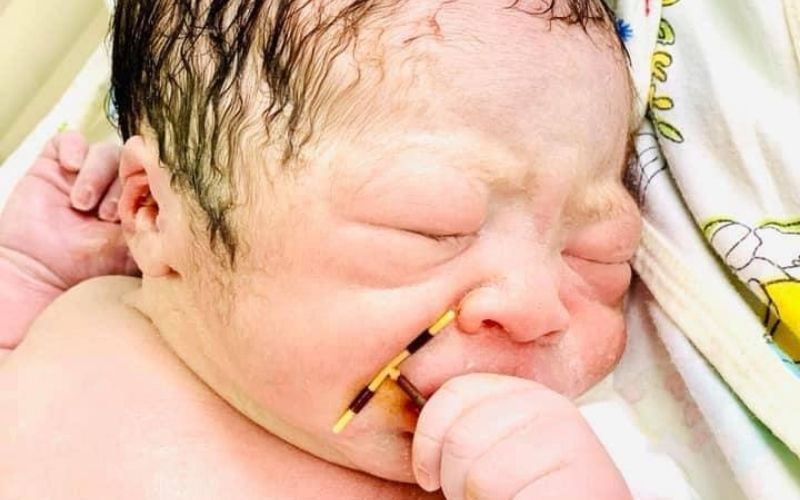 "É um triunfo da vida": Recém-nascido segura dispositivo abortivo usado pela mãe