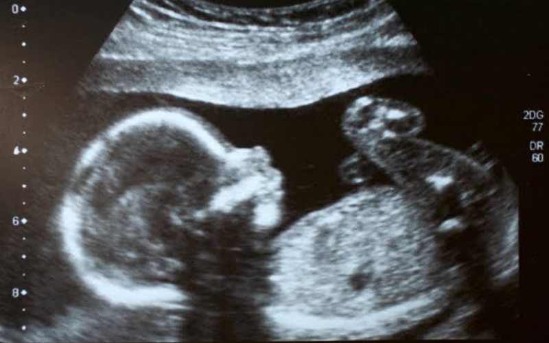 França aprova aborto até 9 meses de gestação